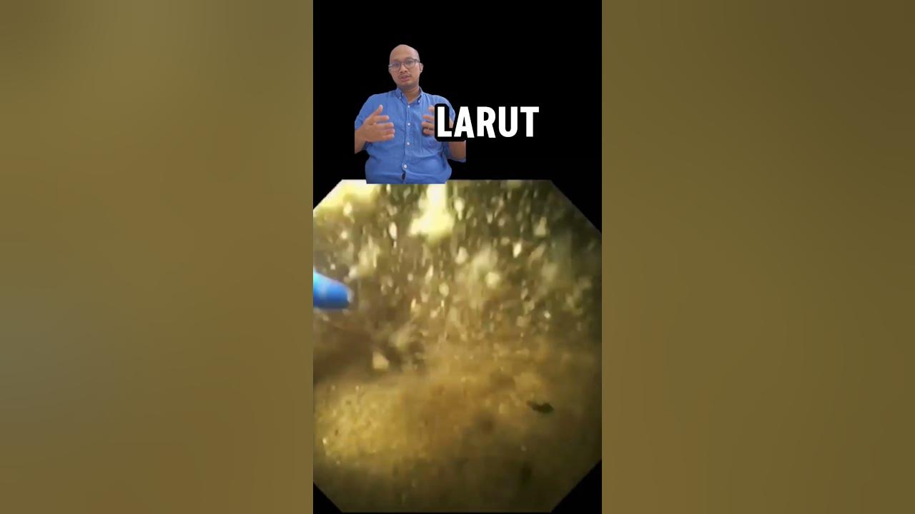 Pecahin batu dengan laser, ga bahaya ta?!! #batuginjal #ginjal #healthinfo #urologi #dokter