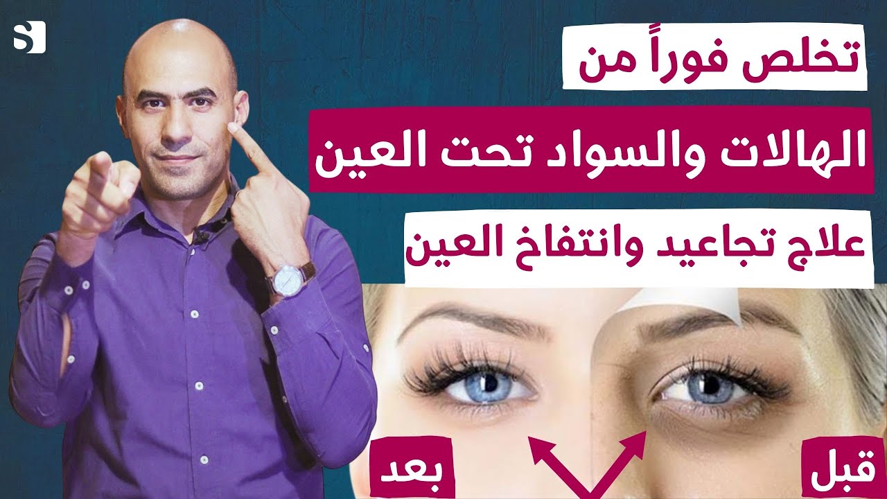 أسرع طريقة للتخلص من الهالات السوداء والترهل والتجاعيد تحت العين | لن تحتاج الى الكريم بعد الان
