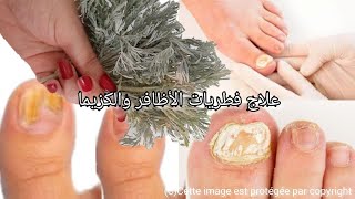 بعشبة الشيبة علاج فطريات الأظافر والكزيما للأبد /وصفة تغنيك عن طبيب/ مجربة /أريد فقط دعوة خير