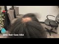 Hair cut on Alopecia client| Female pattern baldness hair cut