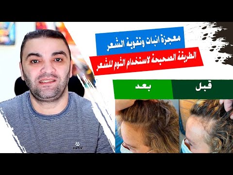 الطريقة الصحيحة لاستخدام الثوم للشعر لو عرفت تستعمله صح هتنبهر بالنتيجة