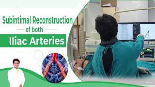 Iliac Artery Angioplasty.