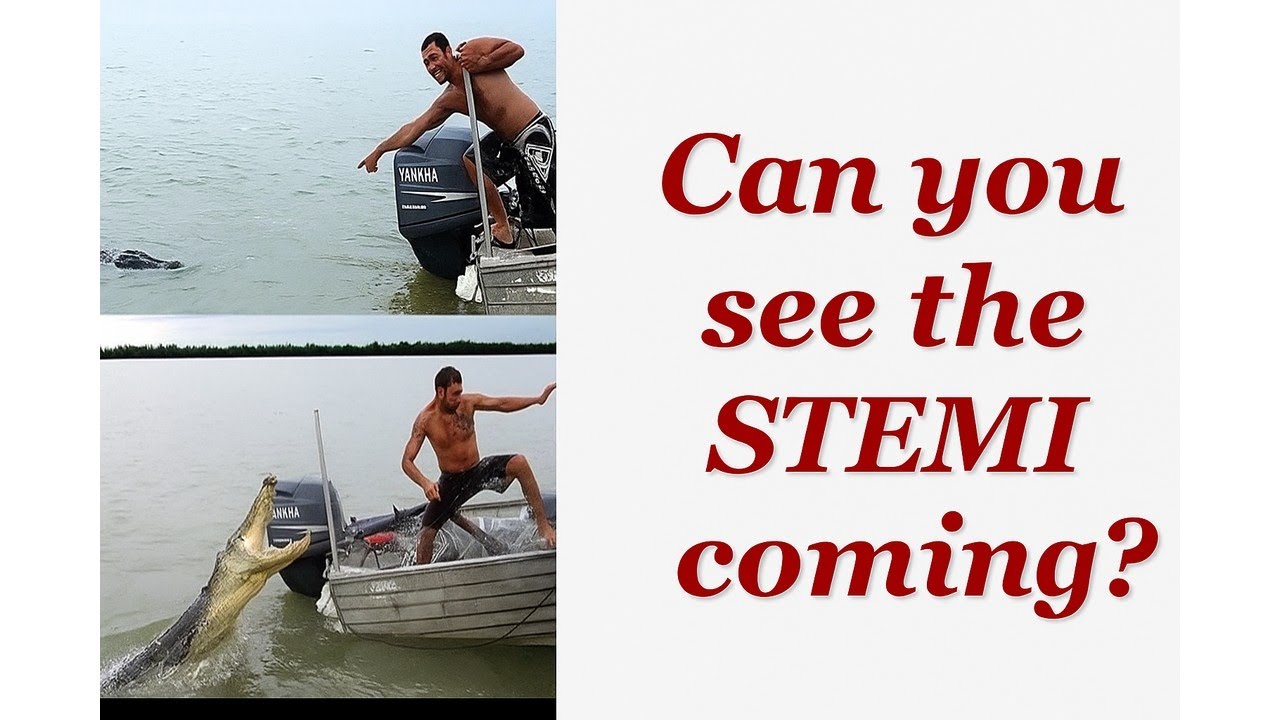 ECG Mastery: De Winter Sign — Subtle but Deadly STEMI Equivalent