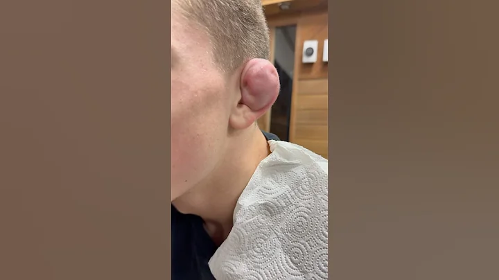 Cauliflower ear drain - yes it’s sanitized #jiujitsu #bjj #cauliflower #grappling #wrestling #drain