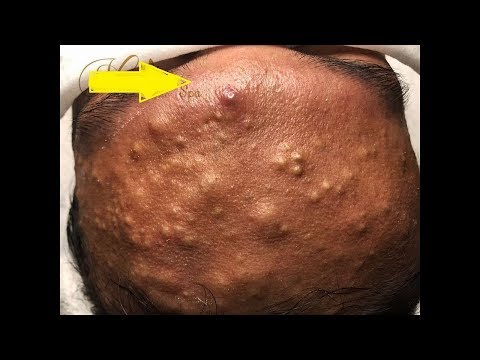 How To Remove Back Acne Fast At Home