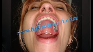 Girl At The Dentist Getting Gold Bridge Amalgam Fillings Treatment -Babesmouth Set 109 G5