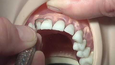 Anterior Sickle Scaler