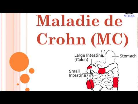 Vidéo: Maladie De Crohn: Causes, Symptômes, Diagnostic, Etc