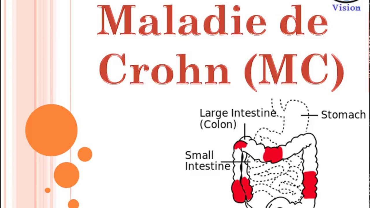 Maladie de Crohn Crohn Disease Symptomes Diagnostic Spondylarthropathies YouTube Maladie de Crohn Crohn Disease Symptomes Diagnostic Spondylarthropathies YouTube