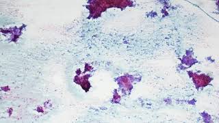 Pleomorphic adenoma Cytology