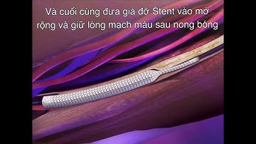 Can thiệp động mạch chi dưới - DrJoseph Tuan