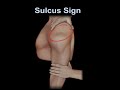 Sulcus Sign, shoulder instability