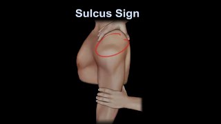 Sulcus Sign, shoulder instability