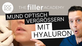Optisch breiterer Mund durch HYALURON FILLER?! TFA by Dr. Rolf Bartsch