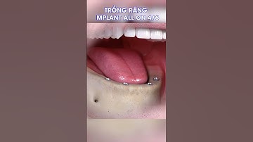Trồng răng implant toàn hàm ra sao?