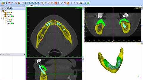 Panoramic curve on mandible.