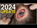 The 2024 Neuralink Update Is Here!