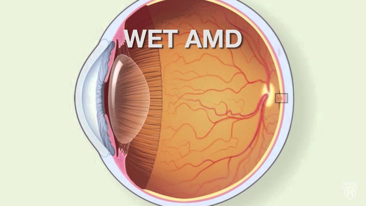 Retinal diseases - Symptoms and causes - Mayo Clinic