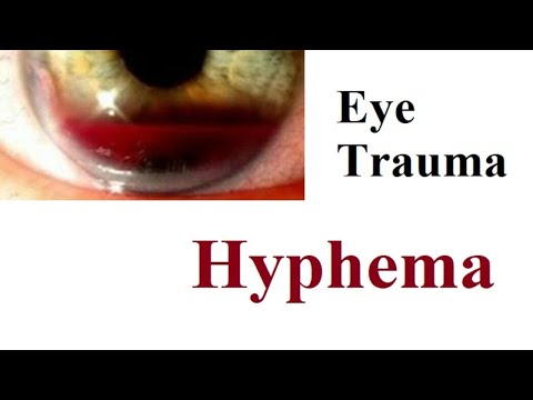 Video: Hyphema - Anzeichen, Behandlung, Ursachen, Formen, Diagnose