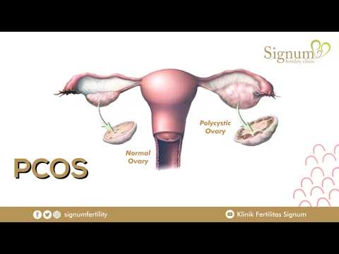 Sindroma Ovarium Polikistik (SPOK) - Signum Fertility Clinic