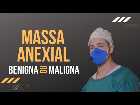 Massa anexial, benigna ou maligna?