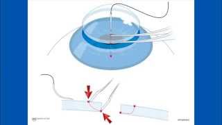 Corneal Suturing, Part 2 - Placing the Needle Into the Graft