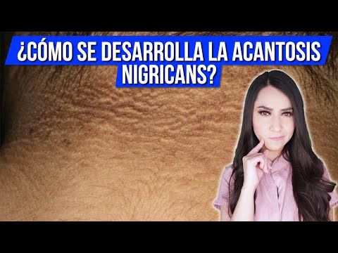 Video: ¿Cómo se desarrolla la acantosis?