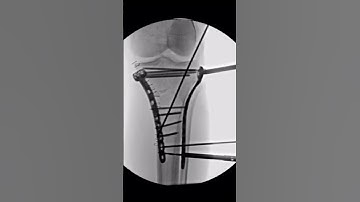 Fracture table in proximal tibia fractures?