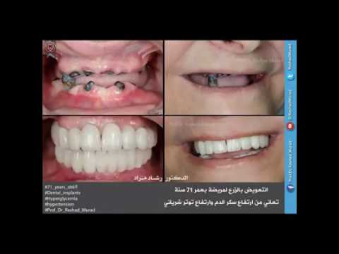 بعض حالات الزرع لأفضل دكتور أسنان في العالم الدكتور رشاد مراد