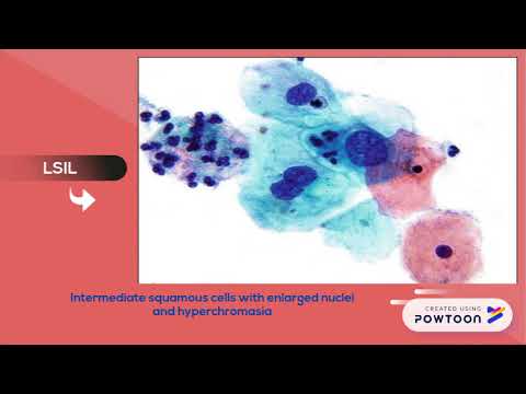 цитограмма lsil