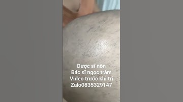 rụng tóc mảng.bé phương 3 tuổi. video trước khi trị