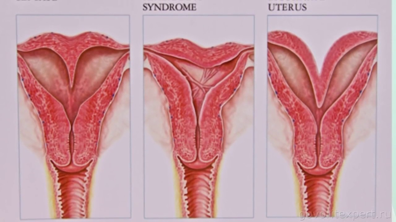 Что такое гистероскопия