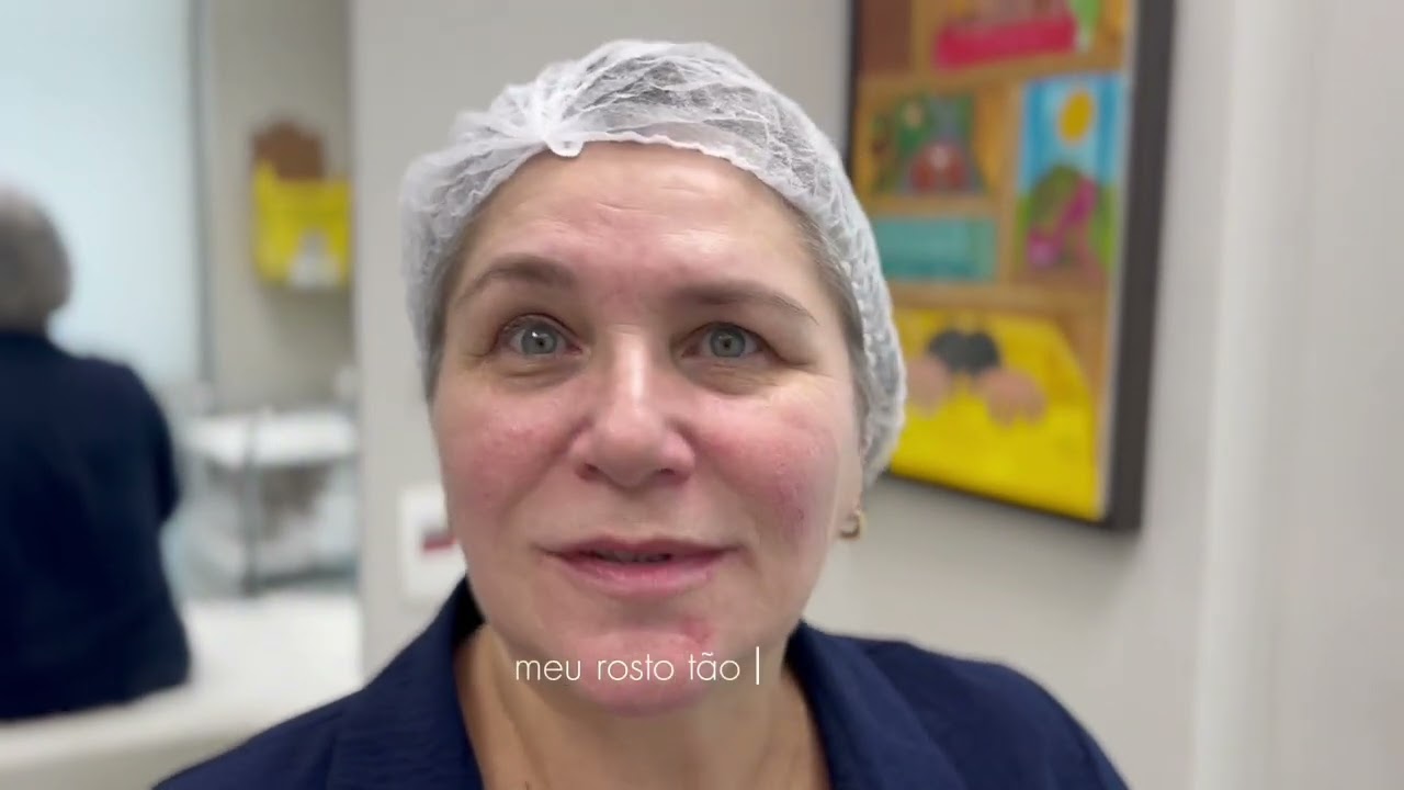 Tratamento para Rosácea