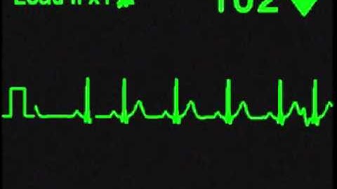 Premature Atrial Contractions (PACs) - ECG Simulator - Arrhythmia Simulator
