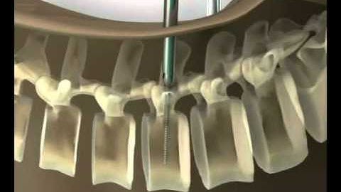 mazor robot 3d