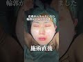 【小顔整形】脂肪吸引から始まる整形物語!施術前から施術直後まで!! #shorts