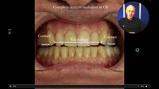 Biting and new complete dentures – the sandwich filling Blog 71 denture occlusion in CR