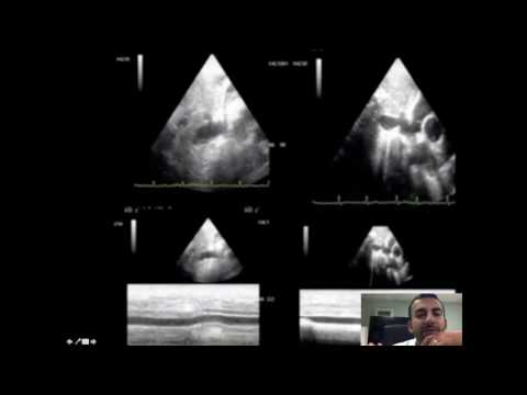 Image of IVC diameter