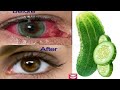 FORGET YOUR EYEGLASS WITH THIS SUPER EYE TREATMENT - Improve Eyesight Naturally with cucumber