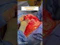 Tummy + Liposuction Surgery Explained by Plastic Surgeon