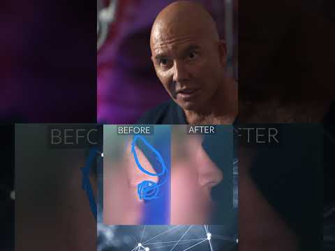 Video thumbnail: Nose transformation by Dr. Mendieta | Call Us: 305-680-5811 #miamiplasticsurgery · 4 Beauty Aesthetics Institute, Inc. - Constantino G. Mendieta, MD, FACS