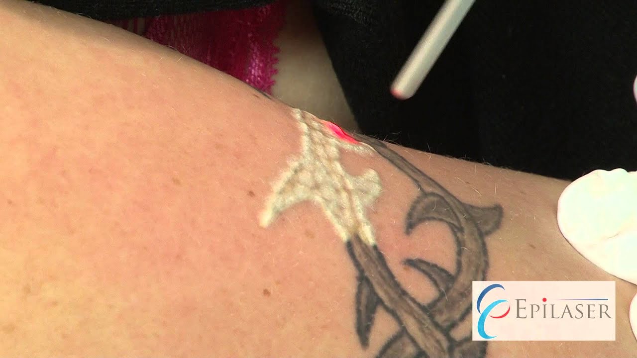 Tatuoinnin poisto laserilla - YouTube
