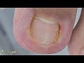 UNHA EMPERRADA (STAKED NAIL) UNHA ENCRAVADA (INGROWN TOENAIL) #satisfying #viral