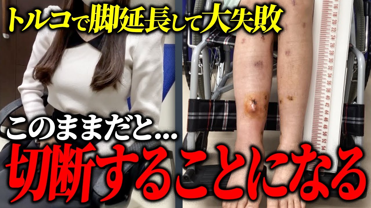 【トルコで脚延長】海外で身長を伸ばした患者様のリアルな声を大公開【骨延長】