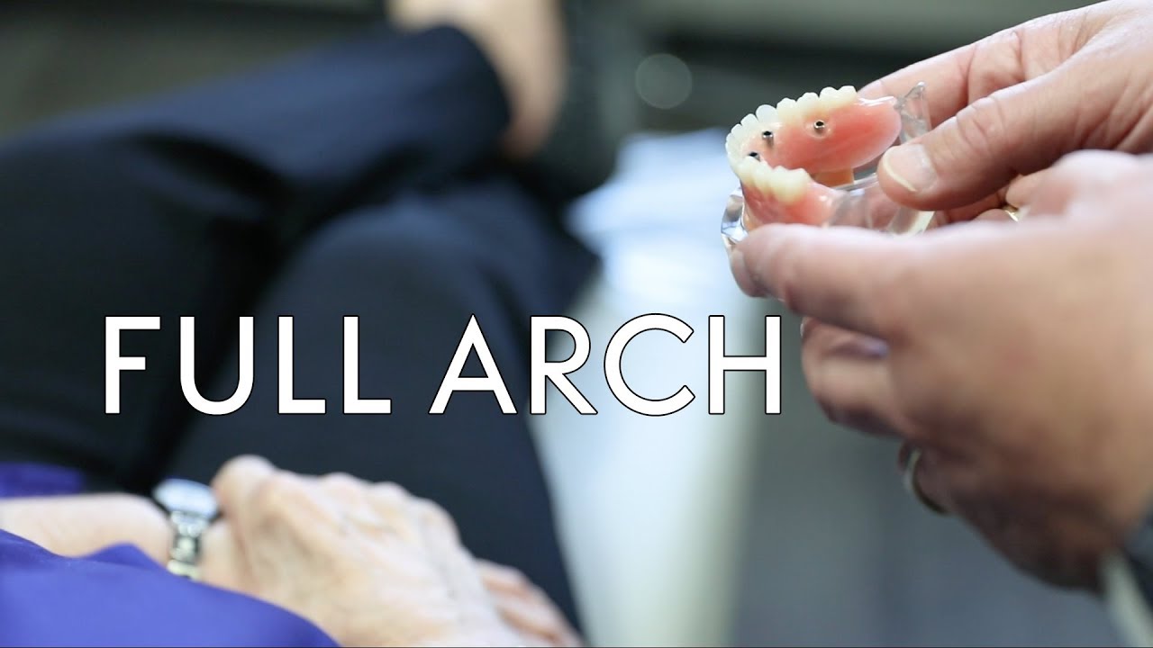 Dr. Schimmele Discusses Common Questions about Full Arch Dental Implants