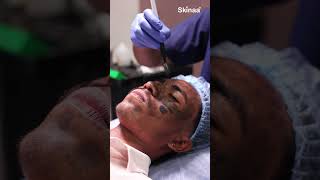 Carbon Laser Treatment: Real Patient Experience in Jaipur #shorts