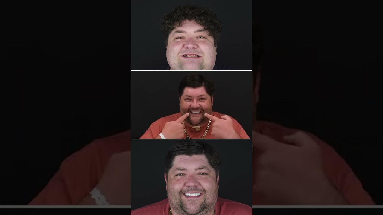 DENTAL VENEERS PROCEDURE Review 🦷 | 