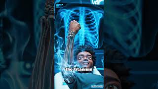 Doctors Replaced His Bone With Titanium 😳