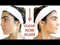 CLEAR ACNE SCARS FAST | DIY Face Masks That WORK
