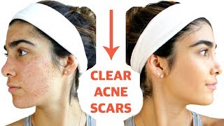 CLEAR ACNE SCARS FAST | DIY Face Masks That WORK